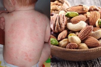 Αλλεργία στα φιστίκια: Πώς να προστατεύσετε τα παιδιά