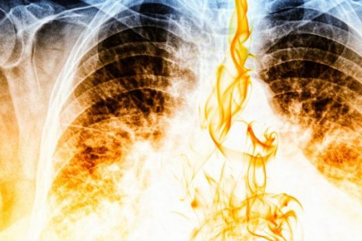 Καρκίνος του πνεύμονα: Πώς σχετίζεται με βήχα. Τι να προσέχετε